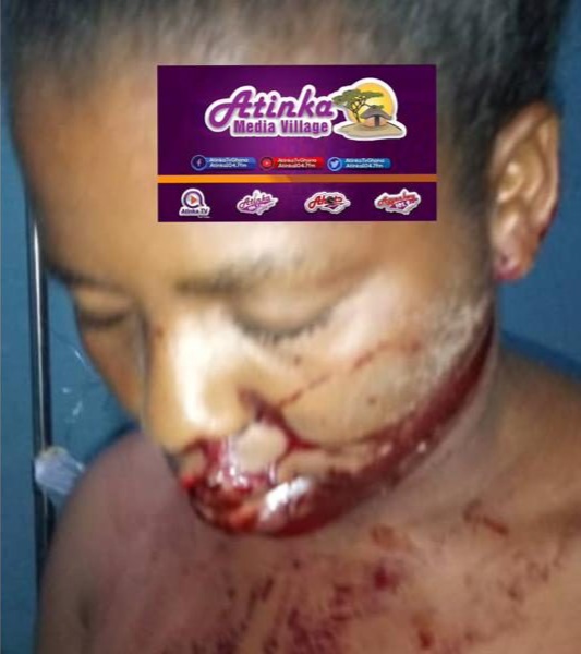 Man inflict cutlass wounds on girlfriend at Adeiso.